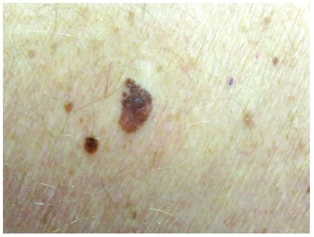 Asymetrická pigmentová léze
V dolní polovině hnědá, v horní šedočerná, nepravidelného tvaru – superficiálně se šířící melanom (složka šedočerná) sekundárně vzniklý ve smíšeném melanocytárním névu levé bederní krajiny.