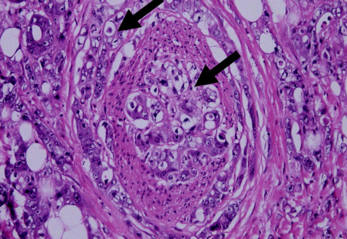 Perineurální a intraneurální šíření karcinomu rekta v mezorektální tukové tkáni (HE, 200x)
Fig. 2. Perineural and intraneural spread of rectal carcinoma in the mezorectal fat tissue (HE, 200x)