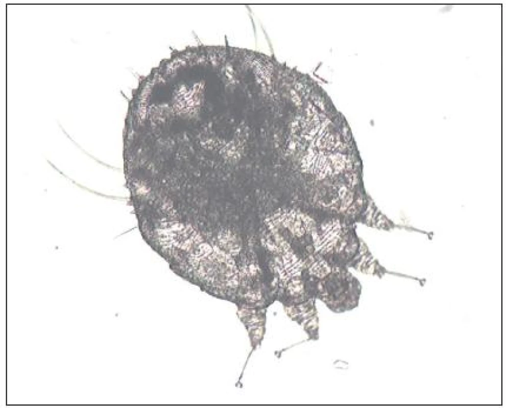 Mikroskopický nález &lt;em&gt;Sarcoptes scabiei&lt;/em&gt; (Danilla T.)