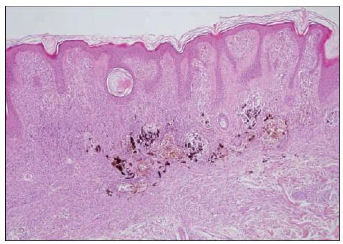 Névus kongenitální intradermální.
V něm uprostřed jsou hnízda hyperpigmentovaných pleomorfních melanocytů. Nález je obtížně s ohledem na posouzení vznikajícího melanomu.