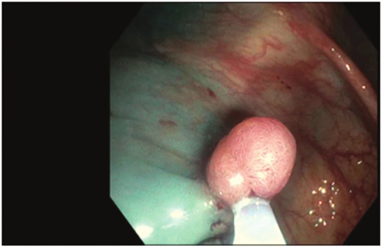 Odstranění polypu metodou endoskopické polypektomie
Fig. 1: Polyp removal by endoscopic polypectomy