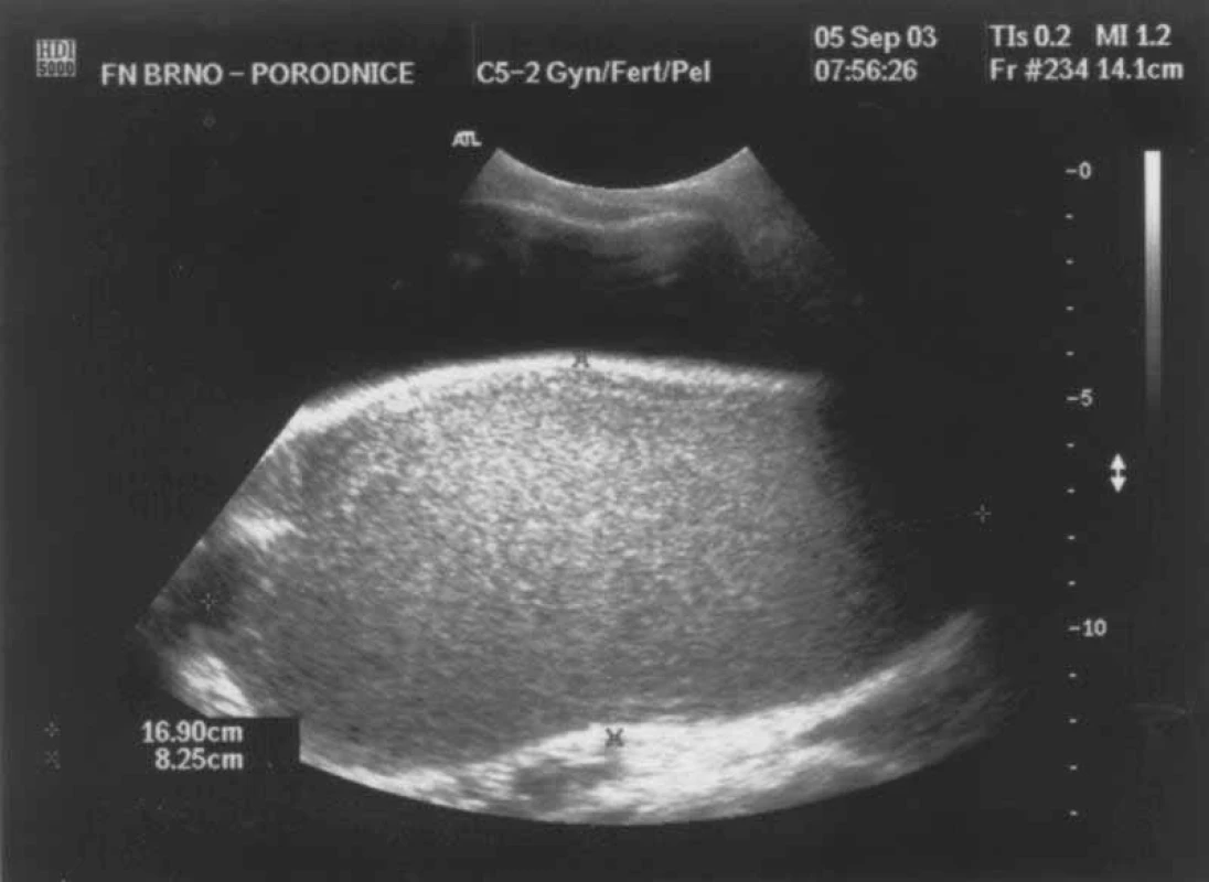 Ultrazvukové vyšetření: hematokolpos.