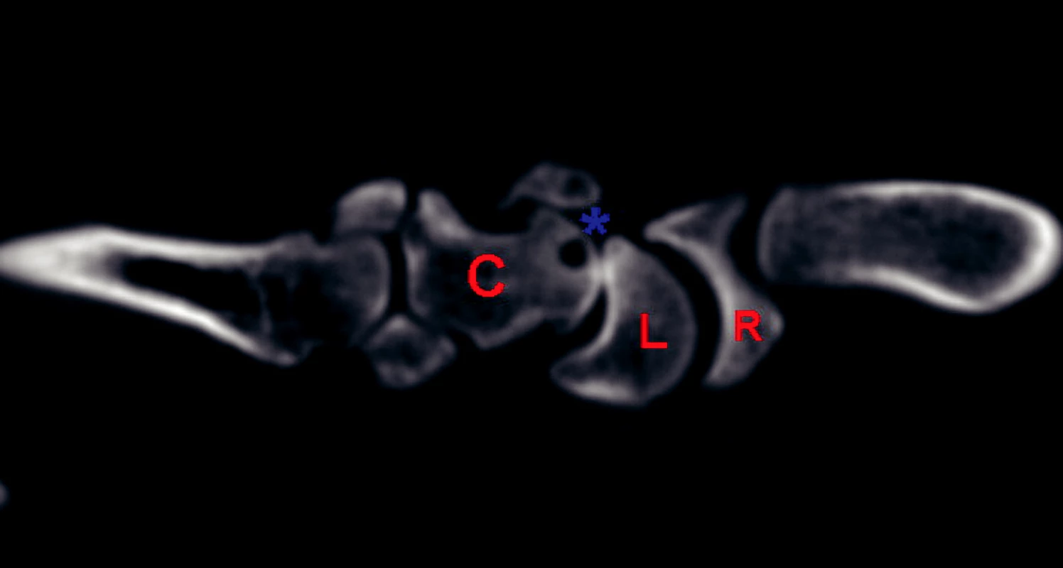 CT scan zachycující artrotické změny v mediokarpálním kloubu.
R = distální část radia,
L = os lunatum,
C = os capitatum.
Hvězdička označuje místo artrotických změn – zúžení kloubní štěrbiny, subchondrální skleróza, cysta v os capitatum.