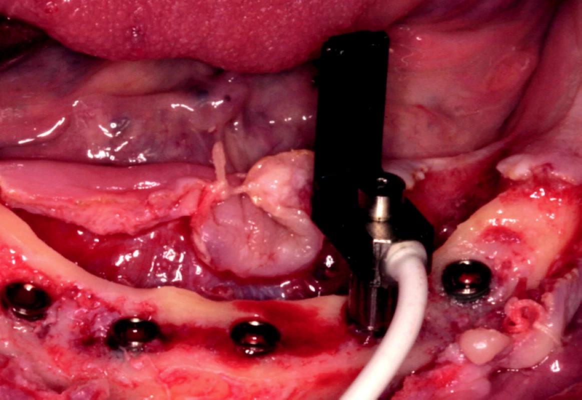 Orientace L segmentu snímače v ústní dutině.