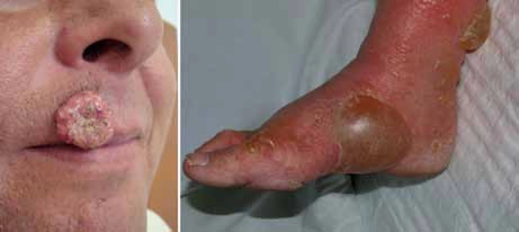 Keratoakantom a bulózní dermatitida jako kožní nežádoucí účinek terapie vemurafenibem.