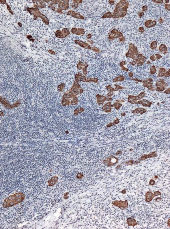 Struktury karcinomu (barveno anticytokeratinem) jsou rozdrobeny agresivním kulatobuněčným zánětlivým infiltrátem.