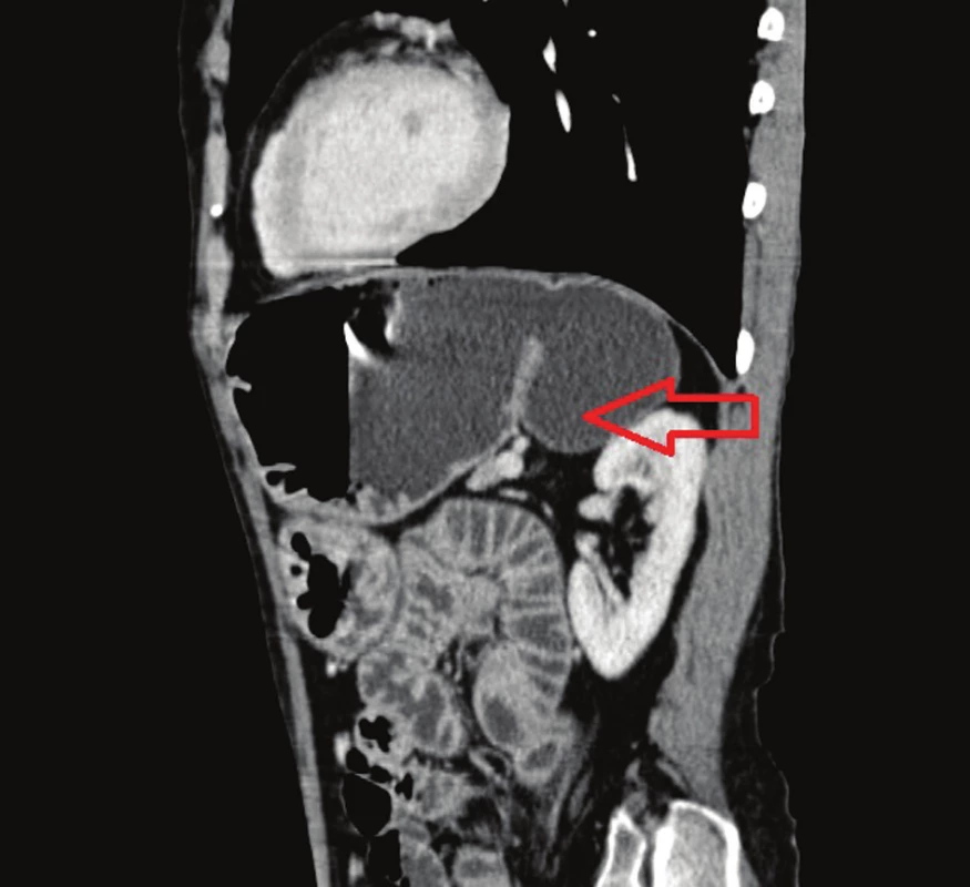 CT – sagitálny rez
Fig. 1: Sagittal CT scan of the gastric diverticulum