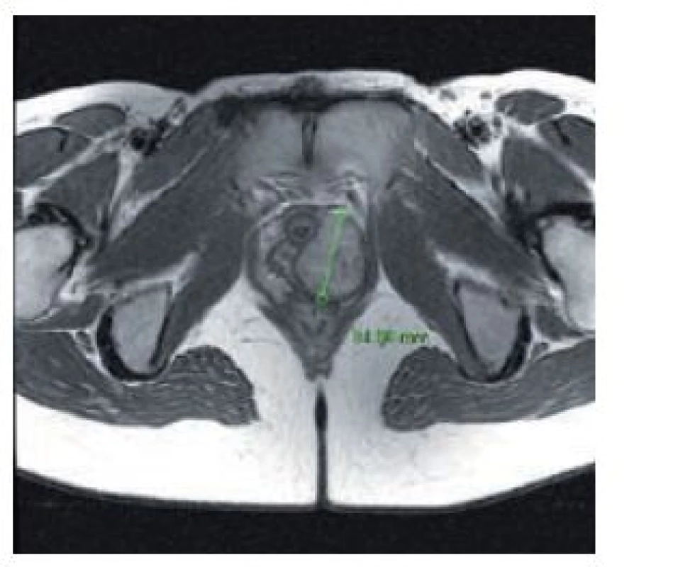 Kazuistika 1 – nukleární magnetická rezonance: solidní tumor v levé části uretrovaginálního septa
Fig. 2 Case report 1 – nuclear magnetic resonance: solid tumor in the left side of urethrovaginal septum