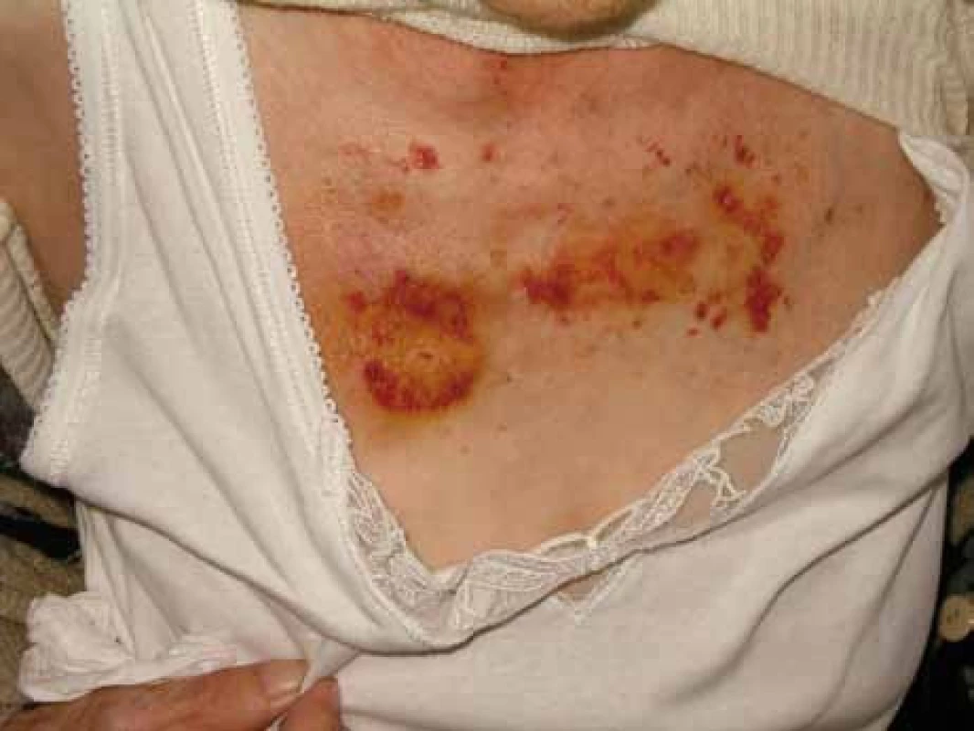 Zvýšená kožní fragilita u pacientky s AL‑amyloidózou.