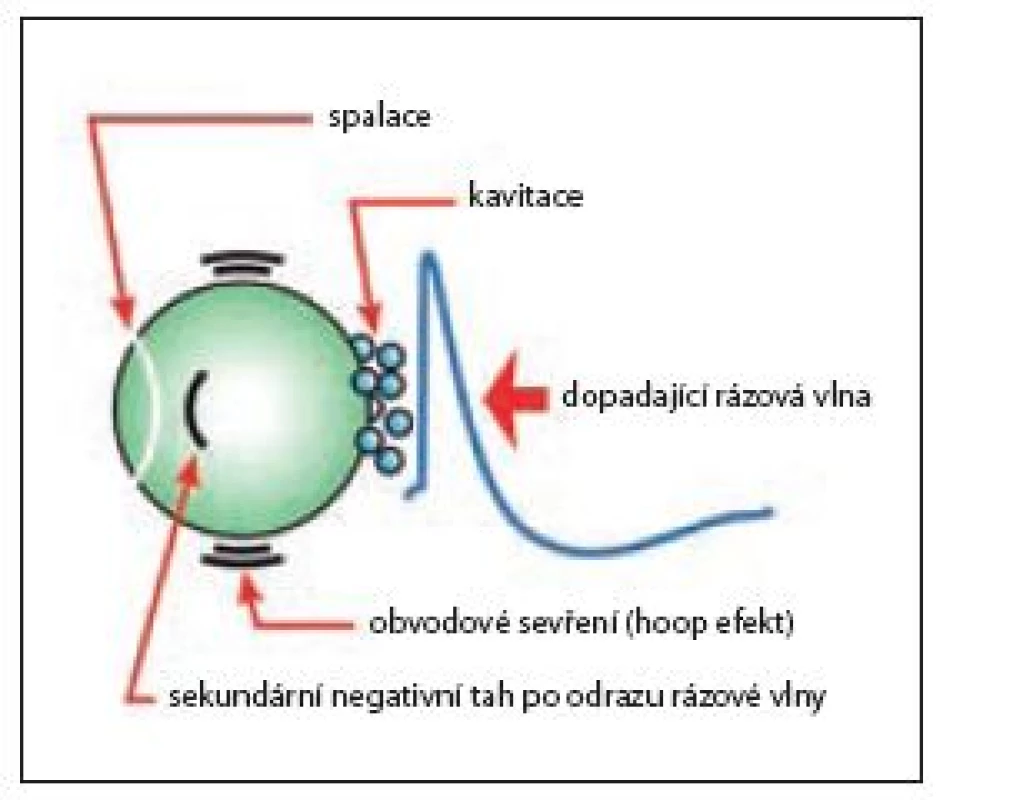 Schematické znázornění mechanizmu desintegrace konkrementu rázovou vlnou
Fig. 10 Mechanism of shock wave action on urinary stone