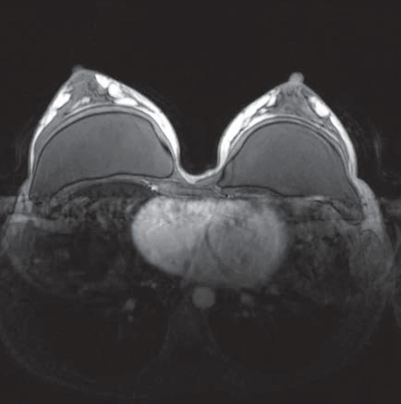 MR-snímek prsu – fyziologické sycení žlázy, oboustranně neporušené silikonové implantáty pod žlázou