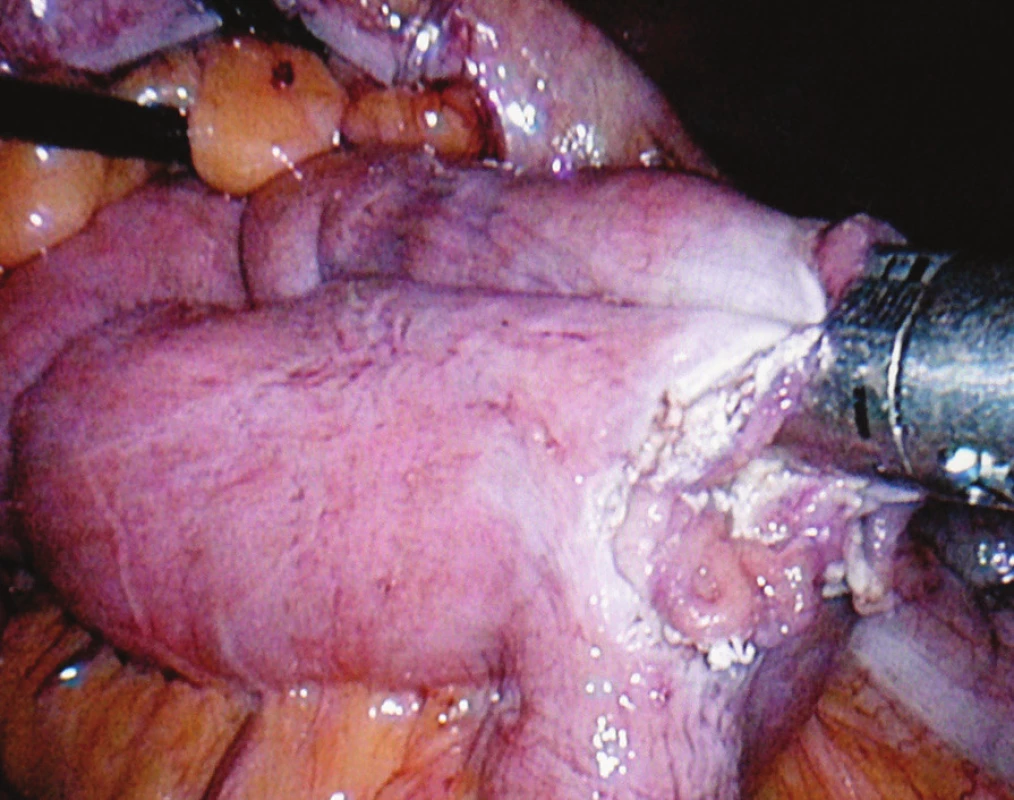 Operační nález: laparoskopická resekce v další fázi výkonu při konstruování Braunovy entero-entero anastomózy lineárním endostaplerem