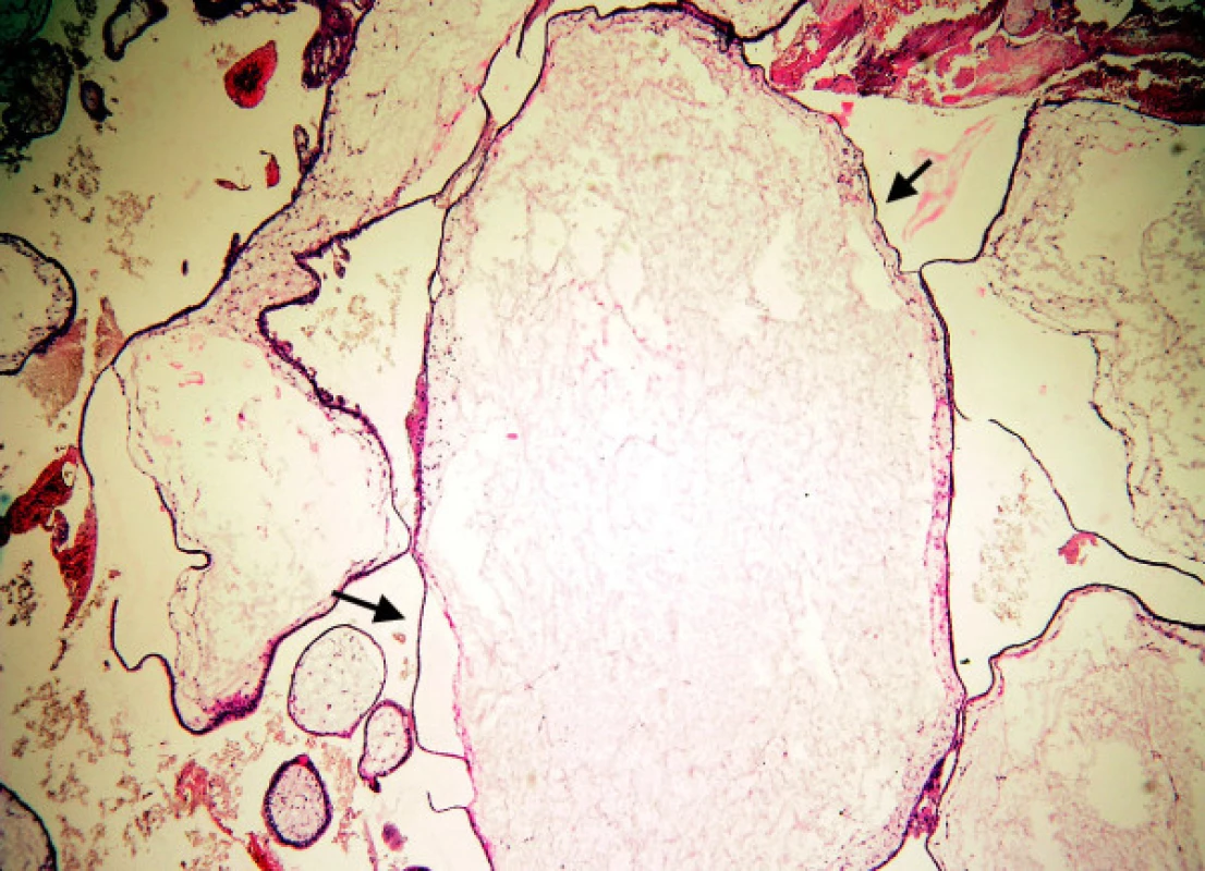 Mola hydatidosa completa: těžký edém klků (mezi šipkami), atrofie trofoblastu centrálních částí moly, cisterny
