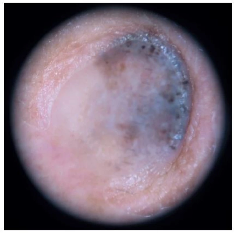 Dermatoskopický nález – asymetricky pigmentovaná léze, na č. 5–11 bílá, na č. 11–12 homogenně hnědá s několika hnědými globulemi, na č. 12–4 bezstrukturní šedomodrá s několika hnědými globulemi