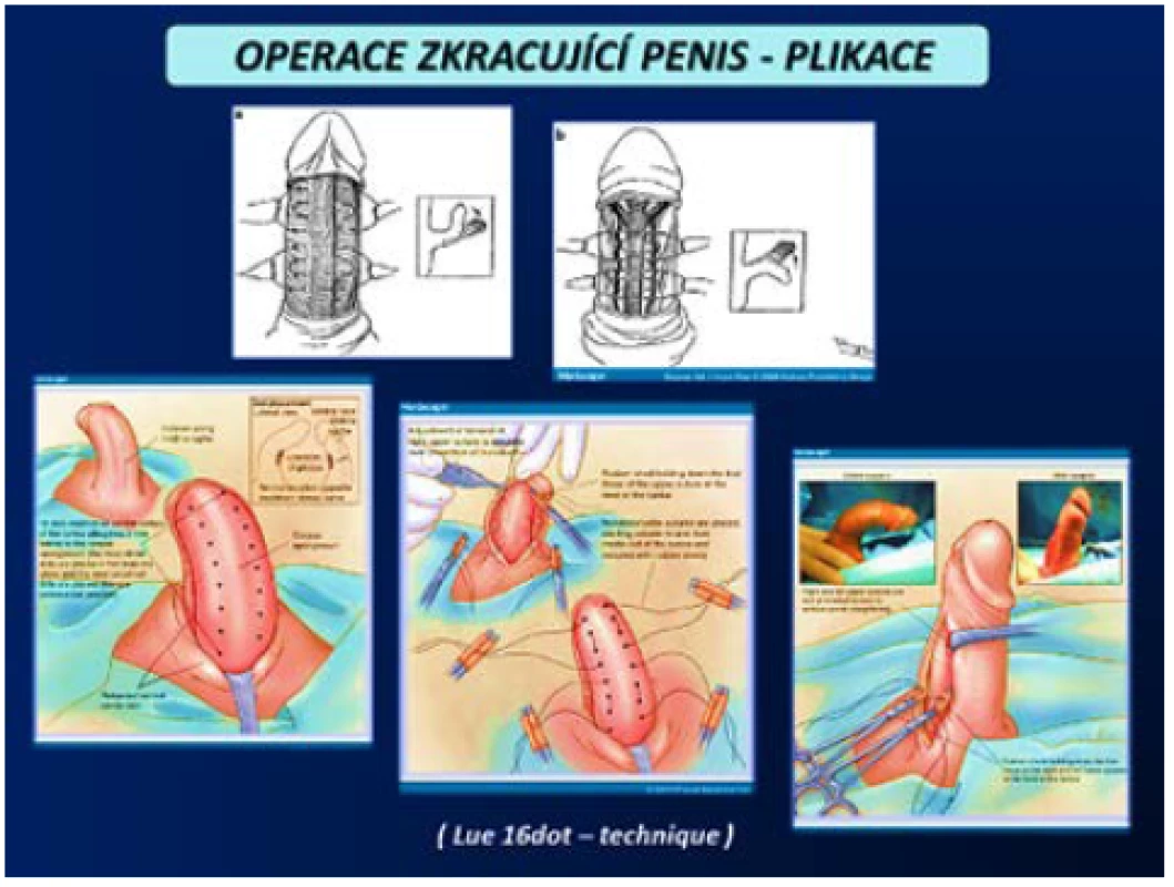 Operace zkracující penis – plikace (3, 4)
Fig. 14 Shortening penis procedures – plication (3, 4)