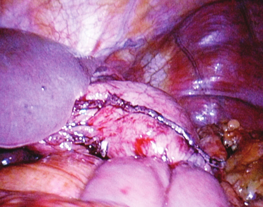 Operační nález: laparoskopická subtotální resekce, žaludek přerušený staplerem, na jeho zadní stěně je dokončená anastomóza na „omega“ kličku tenkého střeva
