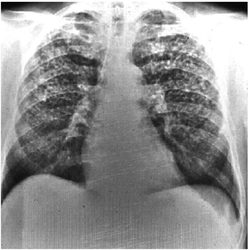 Prostá silikóza plic
S výjimkou plicních bazí jsou v celých plicích patrné početné malé opacity o velikosti do 10 mm.