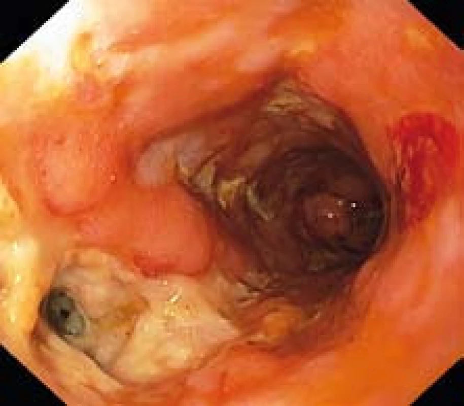 Endoskopický pohled do anorektálního přechodu s hlubokým vředem a ústím píštěle.
Fig. 1. Endoscopic view to the anorectal junction with deep ulcer and fistula orifice.