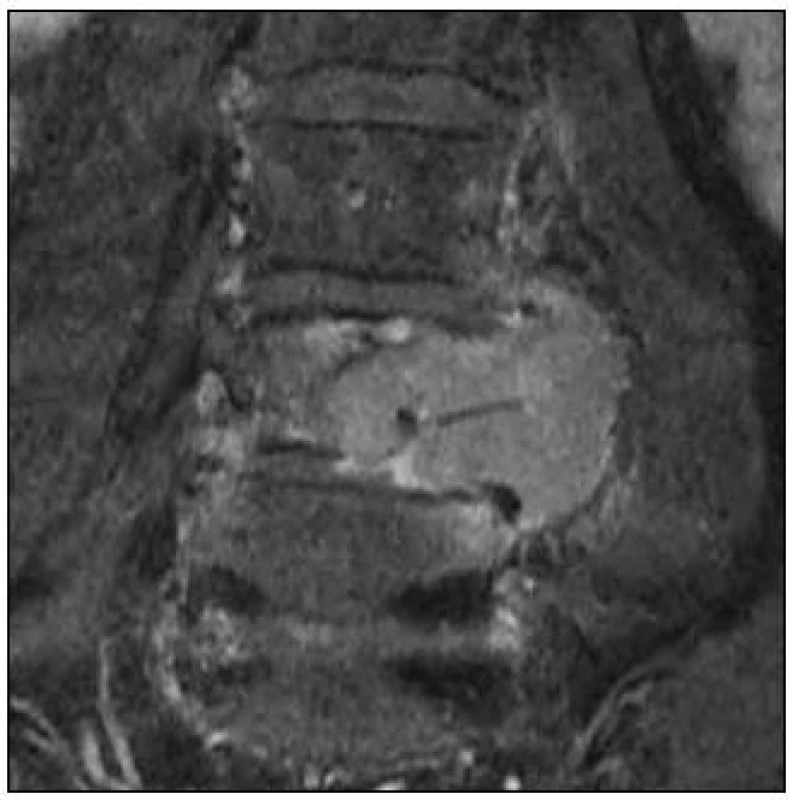 MR, T1 vážený obraz, koronální rovina. Paragangliom extradurální a paravertebrální na etáži L3–L5 vlevo, hyperintenzní tumor po podání kontrastu.
