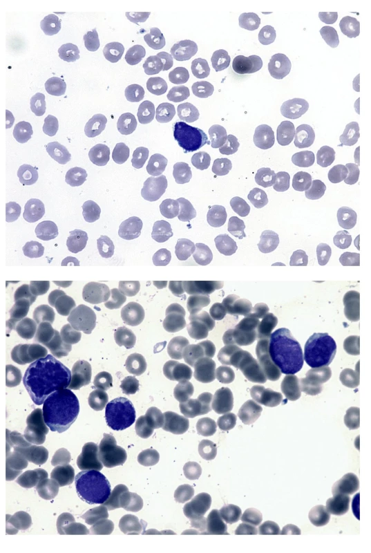 Nátěr periferní krve a kostní dřeně (kazuistika 2)
a – na nátěru periferní krve jeden blastický element menší velikosti s velkým nukleo-cytoplazmatickým poměrem, jemným chromatinem s několika jadérky, cytoplazma je bazofilní, bez granulace a vykazuje jemnou vakuolizaci a drobný výběžek.
b – nátěr kostní dřeně při relapsu po alogenní transplantaci. Blasty s jemnou vakuolizací cytoplazmy připomínající vzhled „perlového náhrdelníku“ podél okraje cytoplazmy.