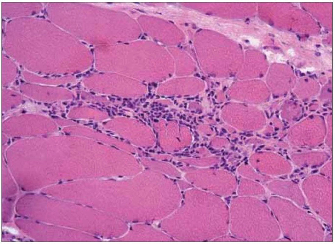 Polymyozitida – v přehledném barvení je zřetelný myopatický vzorec změn s kolísáním velikosti svalových vláken od normy po atrofii, s degenerací svalových vláken a přítomností endomyziálního lymfocytárního infiltrátu.
Barvení hematoxylinem a eozinem, originální zvětšení 200×.