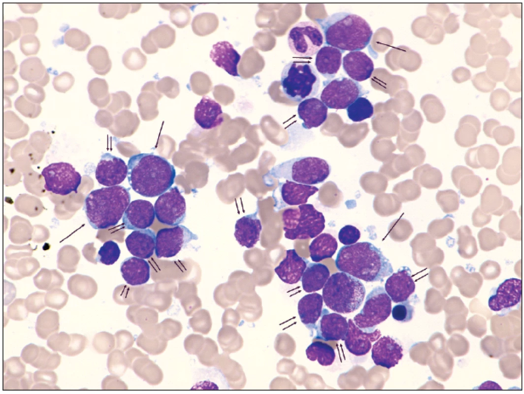 Aspirát kostní dřeně biklonální akutní leukemie – myeloidní /T lymfoblastické, panoptické barvení, 1000 x zvětšení: tři shluky buněk s převahu blastů, jednou šipkou označené blasty myeloidního charakteru, dvěma šipkami blasty s lymfoidní morfologií, neoznačené blastické elementy jsou obtížně zařaditelné, četnější blastické jaderné stíny, ojediněle erytroblast, méně zralé granulocyty, zralé lymfocyty.