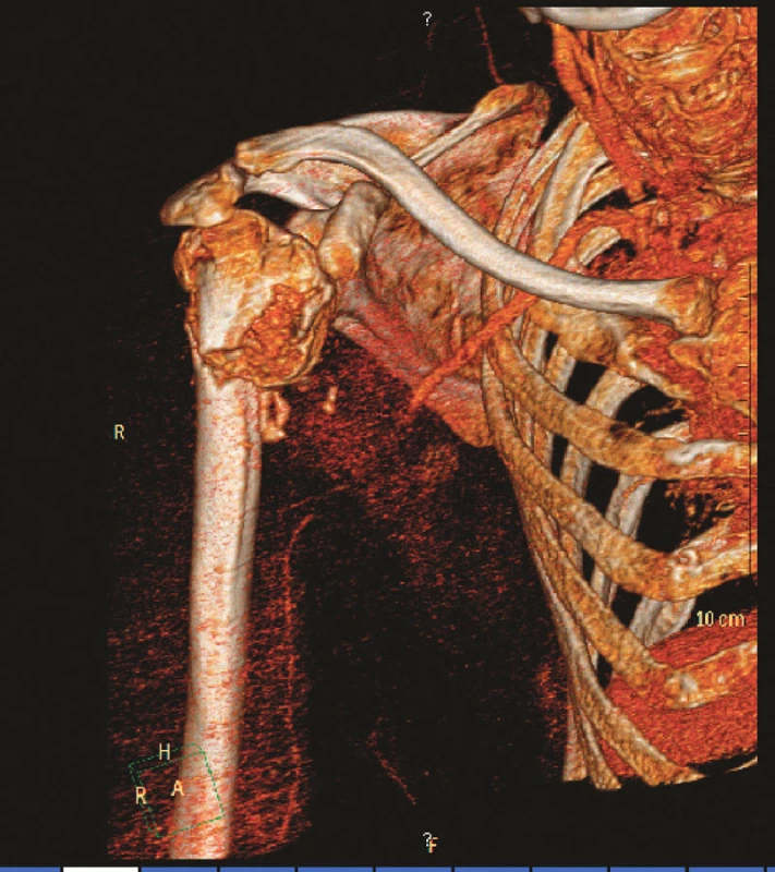 3D CT angiografie s patrnou okluzí 3. segmentu arteria axillaris
Fig. 1. 3D CT angiography depicting occlusion of the 3rd segment of the arteria axillaris