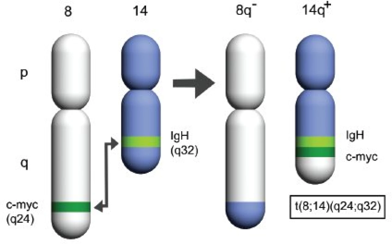 Schéma charakteristické chromozomální translokace u Burkittova lymfomu.