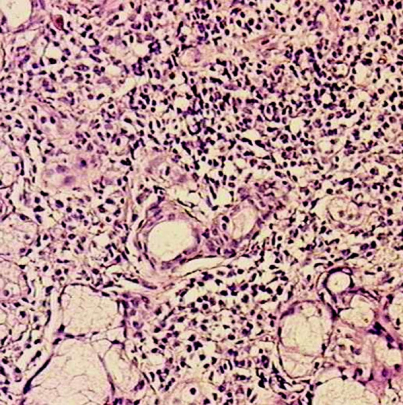 Histologický nález podporujúci diagnózu Sjögrenovho syndrómu: vzorka tkaniva s diskrétnymi lymfocytárnymi infiltrátmi (hematoxylín-eozín, 100x zväčšené).