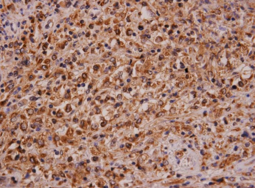 Histiocytární sarkom sleziny (imuno CD68). Nádorové histiocyty jsou pozitivní v imunohistochemickém průkazu lyzosomálního markeru CD68.