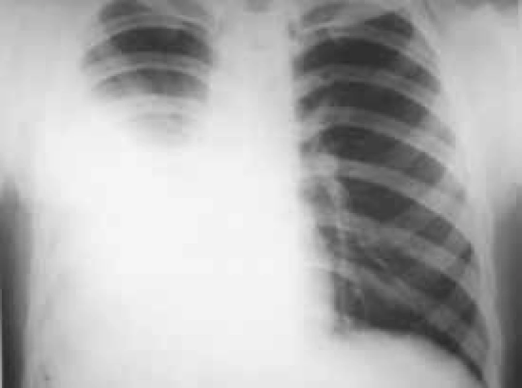 Tuberkulózní pleuritida vpravo