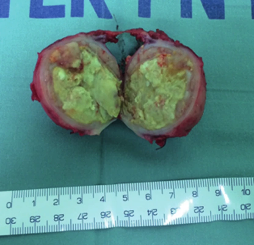Resekát primárního tumoru
Fig. 4: Resected primary tumour