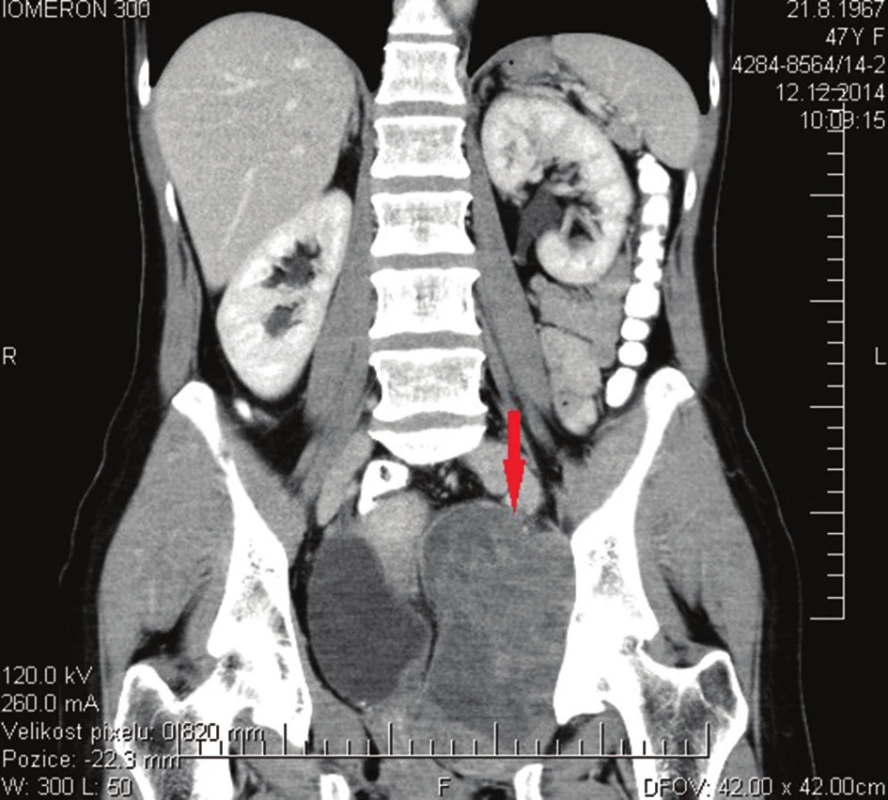 CT vyšetření v době stanovení diagnózy
Fig. 1: CT scan at the time of diagnosis