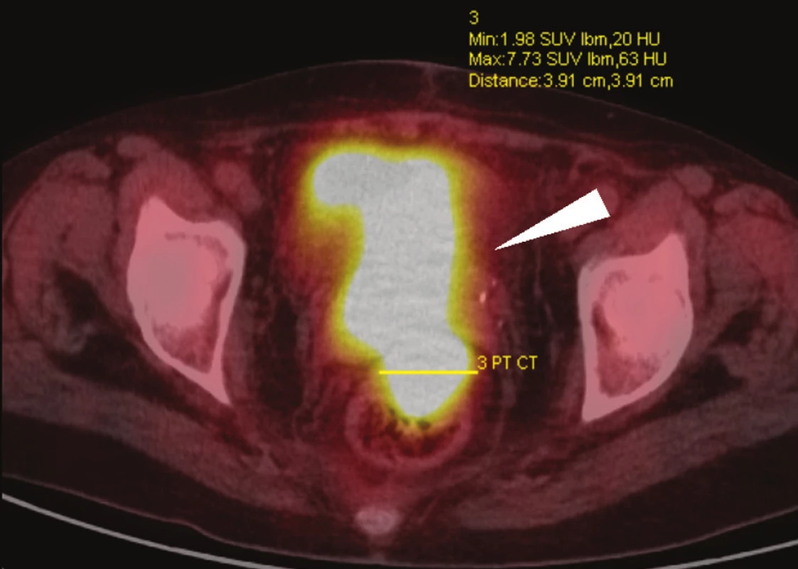 PET/CT vyšetření, axiální skeny: rozsáhlý tumor malé pánve, postihující rektum, pochvu a močový měchýř (bílá šipka) – vyšetření u stejné nemocné jako na Obr. 2.
Fig. 4: PET/CT, axial scans: advanced tumour of the small pelvis, invading the rectum, vagina and urinary bladder (white arrow) – findings in the same patient as shown in Fig. 2.