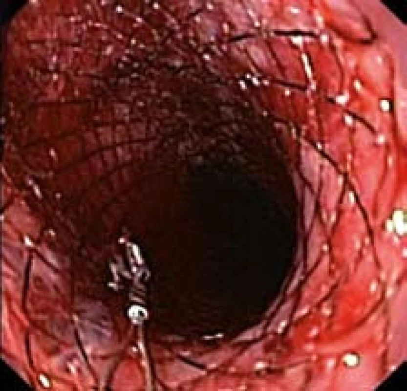Proximální konec stentu po zavedení do jícnu (endoskopický obraz).
Fig. 9. Proximal end of the stent after application into oesophagus (endoscopic picture).