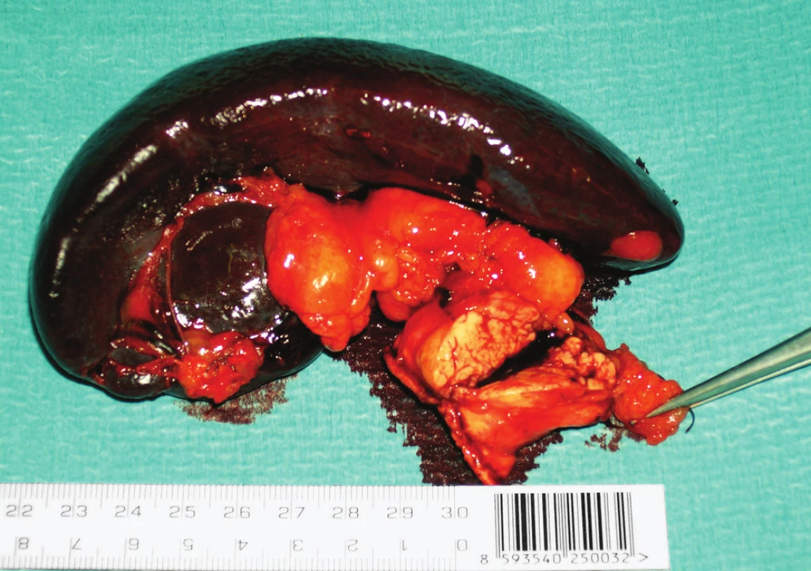 Resekovaná kauda pankreatu se slezinou.
Fig. 4: Resected tail of pancreas with spleen.