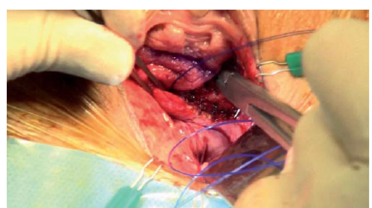 Polypropylenová sutura č. 1 je naložena od vrcholu pochvy směrem k hrdlu močového měchýře. Každý steh by měl zachytit kousek anteriorní vaginální stěny, stehy se nakládají spirálovitě, pro upevnění do vaginální ploténky pod bází močového měchýře je obvykle nezbyté provést několik průchodů jehly. V závislosti na délce přední vaginální stěny je nutné provedení jednoho nebo dvou stehů.