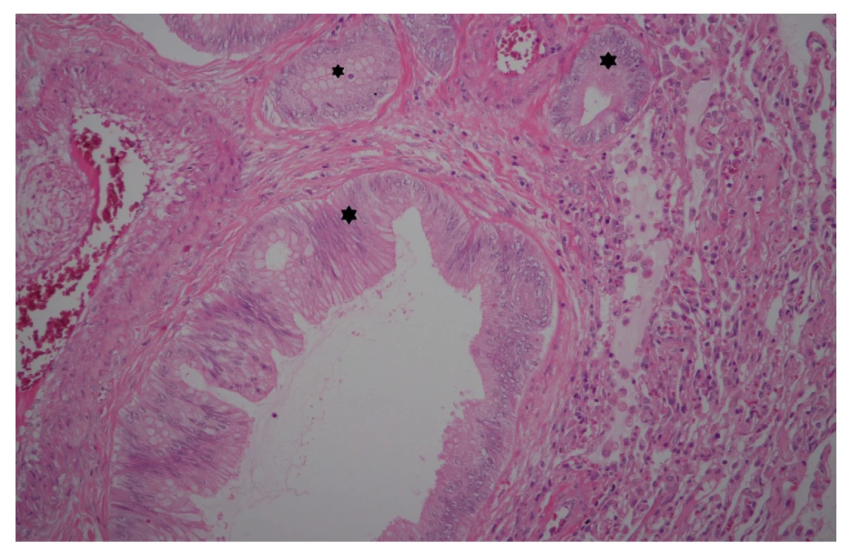 Histologický řez ložiskem v levé plíci, hematoxylin-
eosin<br>
Hvězdičky označují ložiska tumoru.<br>
Fig. 4: Biopsy section of the left lung focus, HE staining<br>
Stars indicate the tumour foci.