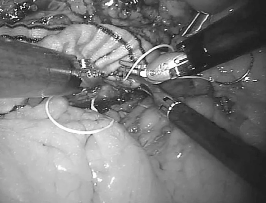 Robotická centrální anastomóza „end-to-side“ aortobifemorální rekonstrukce