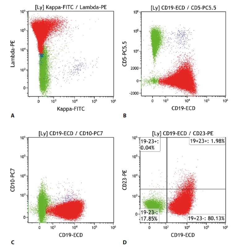 Lymfom marginální zóny. Průtoková cytometrie. Gate na lymfocyty. Buňky MZL červeně, ostatní B lymfocyty modře, T lymfocyty a NK buňky zeleně. A - monoklonální populace MZL s expresí povrchových lehkých imunoglobulinových řetězců lambda, B - MZL exprimuje CD19 a CD5 je negativní, C - MZL neexprimuje CD10, D - negativita CD23 na buňkách MZL.