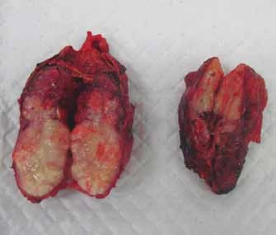 Metastázy obou nadledvin – fotografie preparátu.
Fig. 6 Metastases in both suprarenal glands – photo of the resection specimen.
