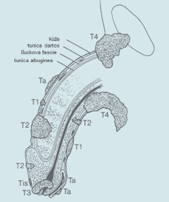 Jednotlivé charakteristiky (T) primárního nádoru penisu.