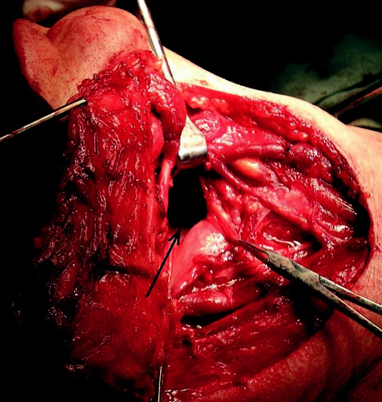 Pohled zvnějšku do nitra hltanu (šipka) při klasické operaci pro karcinom kořene
jazyka s krčním metastazováním (tzv. laterální faryngotomie s blokovou krční dissekcí).