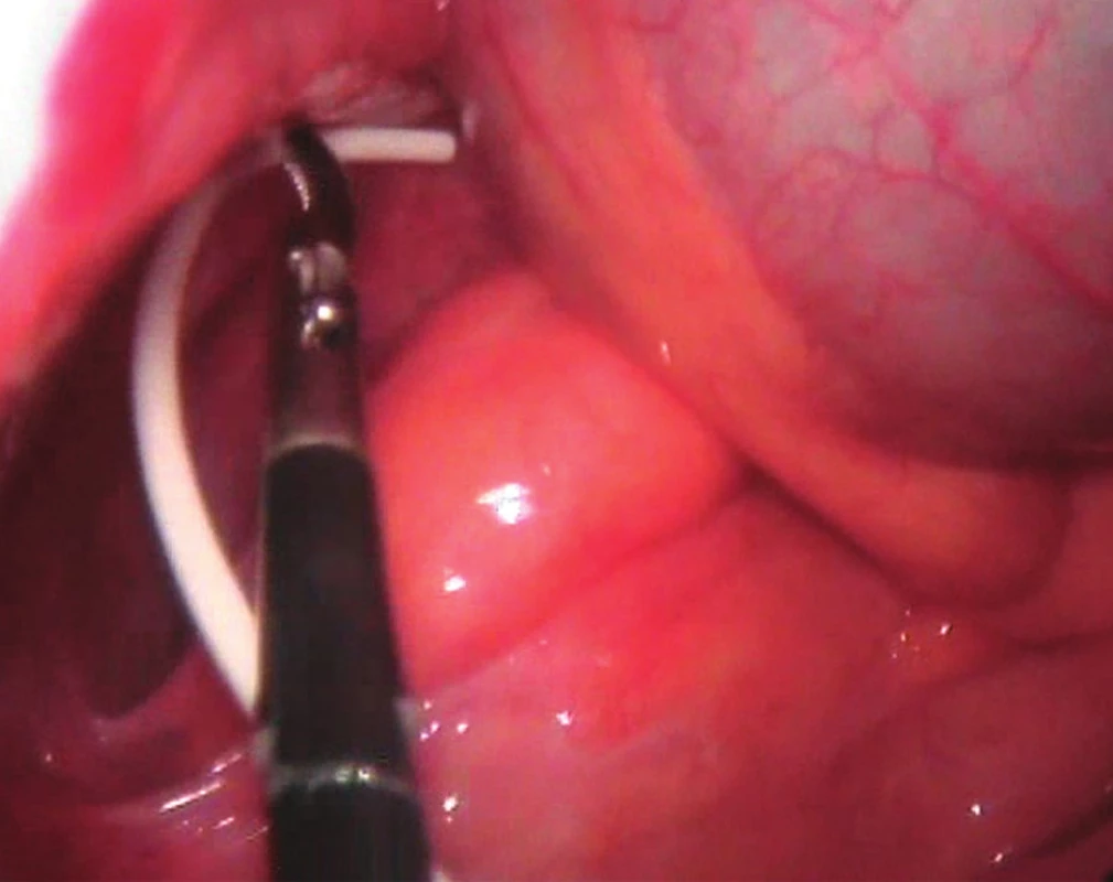 Umístění distálního konce peritoneálního katetru do oblasti malé pánve během laparoskopie
Fig. 1: Laparoscopic placement of the distal end of the peritoneal catheter in the region of the small pelvis