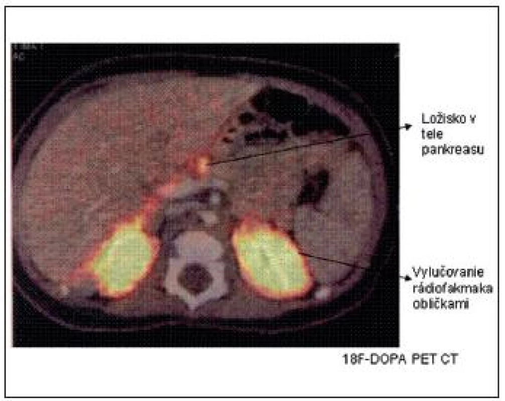 &lt;sup&gt;18&lt;/sup&gt;F-DOPA PET CT scan s nálezom fokálnej lézie tela pankreasu. (Barthlen, JCEM 2008)