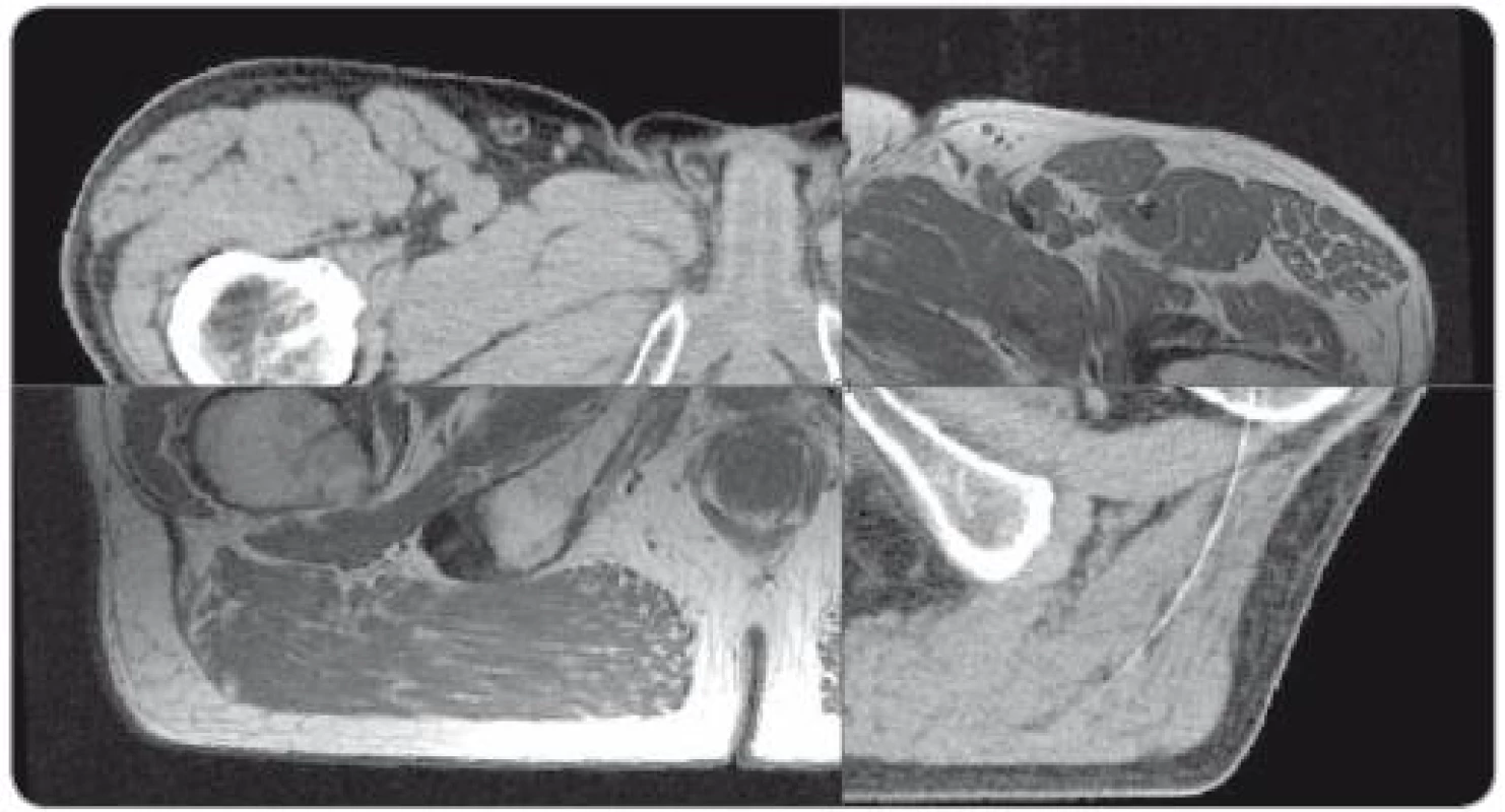 Fúze plánovacího CT s T1 magnetickou rezonancí, odpovídající uložení svalů dna pánevního, bulbus penis a rekta. Neodpovídající uložení pohyblivějších struktur – obrysů těla a hlavic stehenních kostí.