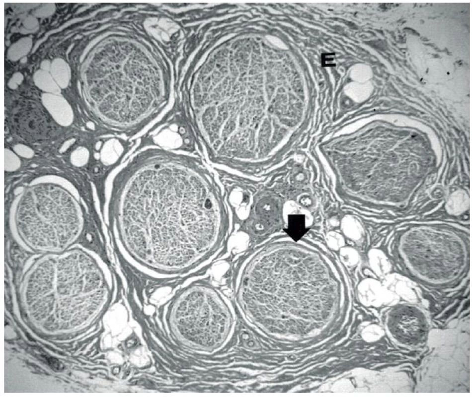 Mikroskopický řez periferním nervem Jednotlivé fascikly jsou obaleny perineuriem (P) a dohromady jsou spojeny epineuriem (E) v makroskopicky patrný periferní nerv.
