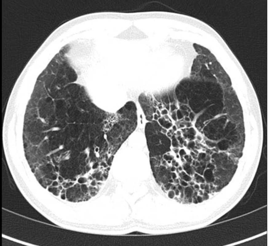 HRCT obraz bronchiektázií vzniklých na podkladě opakovaných aspirací při gastroezofageálním refluxu v dětství