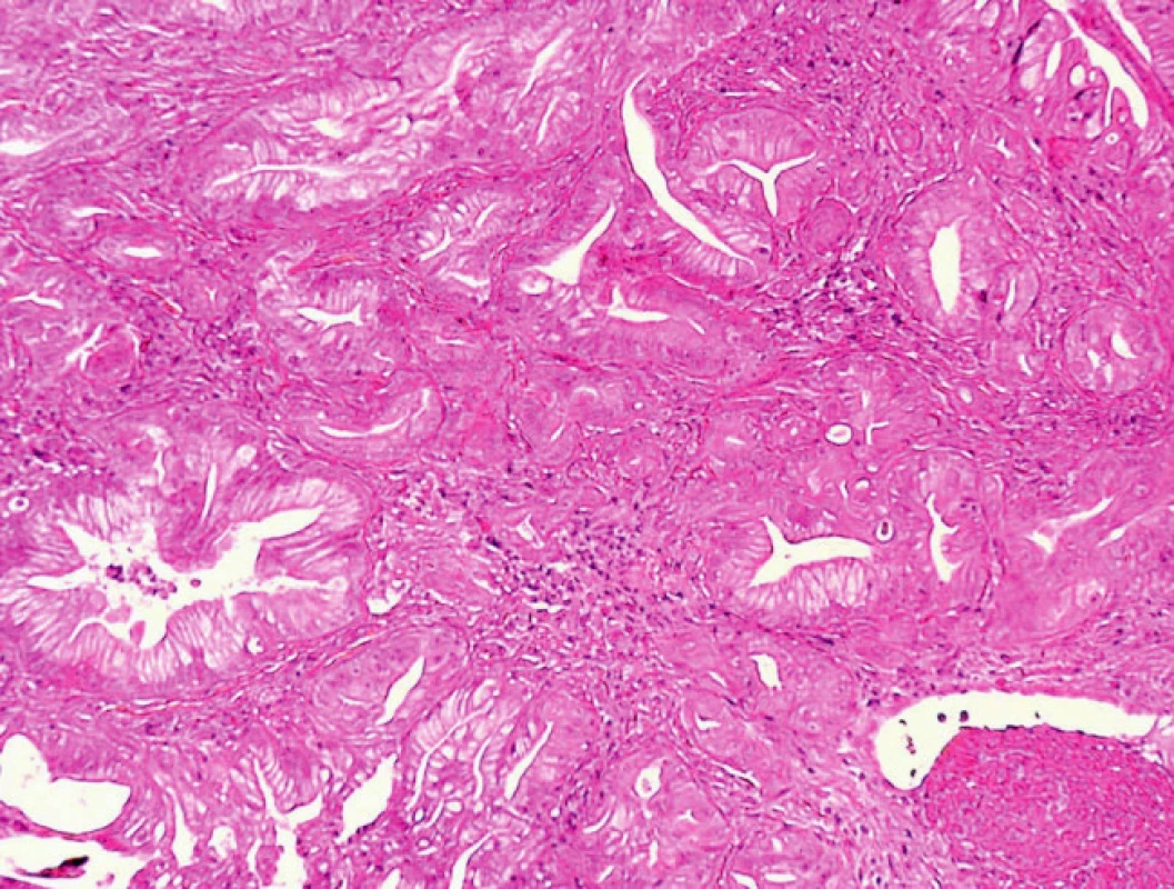 Histologický obraz metastázy adenokarcinomu v pupku (HE, 200x).