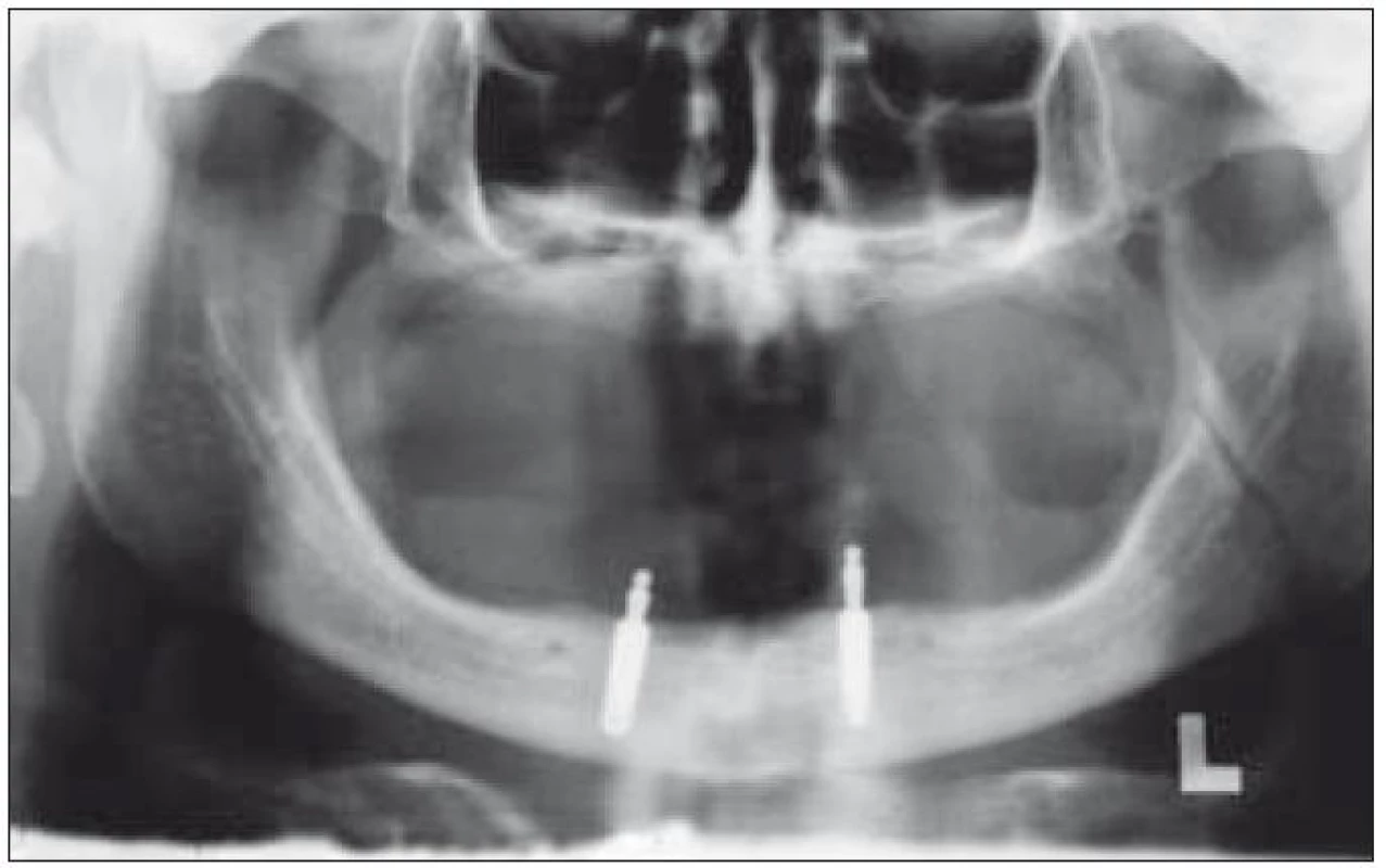 Panoramatický RTG snímek horní a dolní čelisti. Dolní čelist se zavedenými enoseálními implantáty.